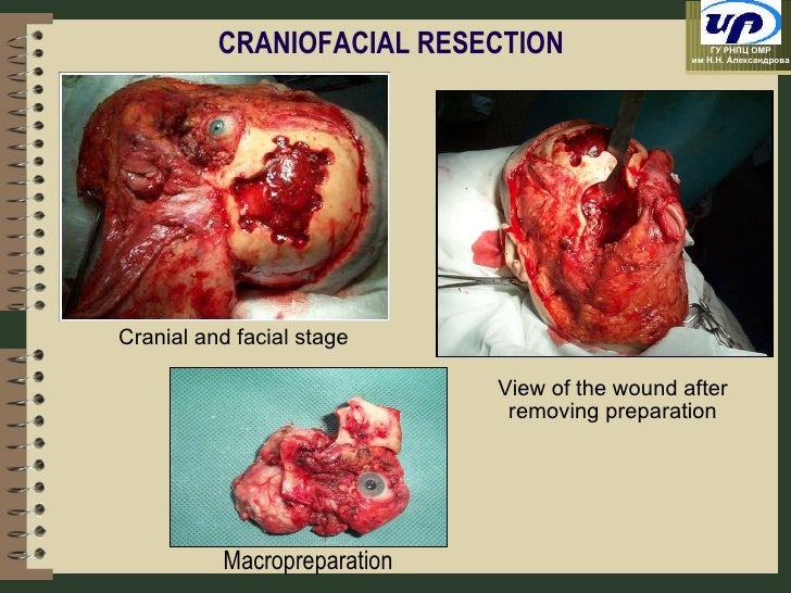 Nonconsent gangbanged wife Cranio facial resection